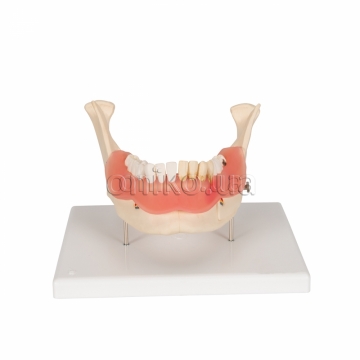 Model onemocnění zubů