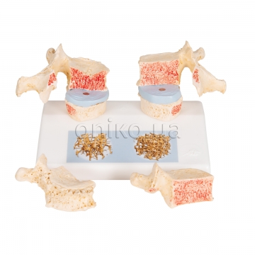 Model osteoporózy